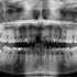آیا ریشه دندانی که در سینوس است خطرناک است و نیاز به درمان فوری دارد؟